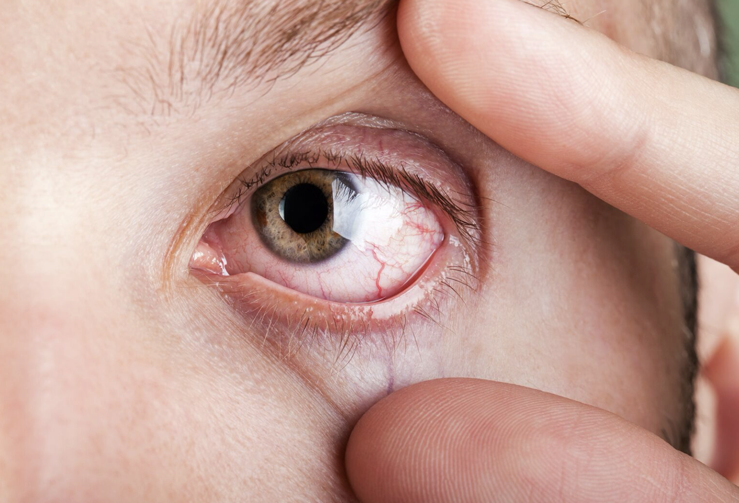 眼睛沒痛沒腫卻出事？這些「無聲眼疾」超多人中招